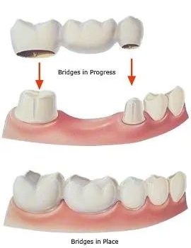 dental-bridge-608w